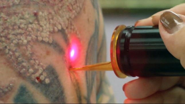 cómo remover tatuajes