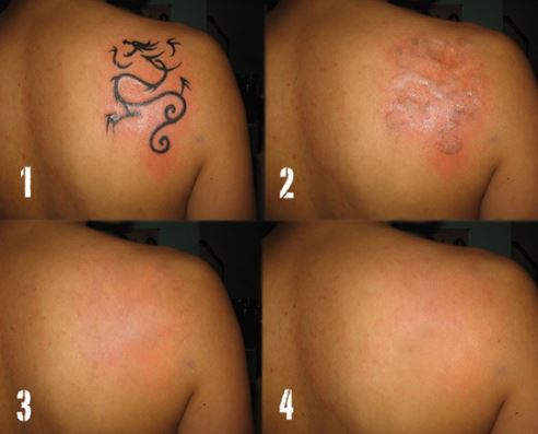 cómo remover tatuajes